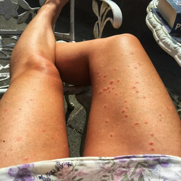 stress-induced psoriasis