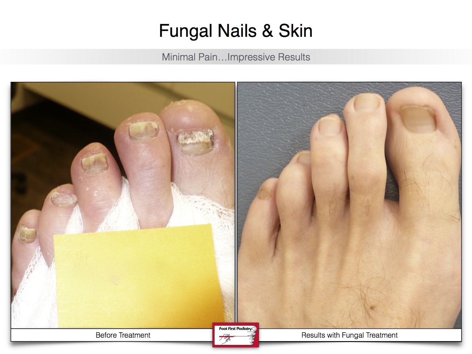 Fungal Nails & Skin 02.16 21.jpg