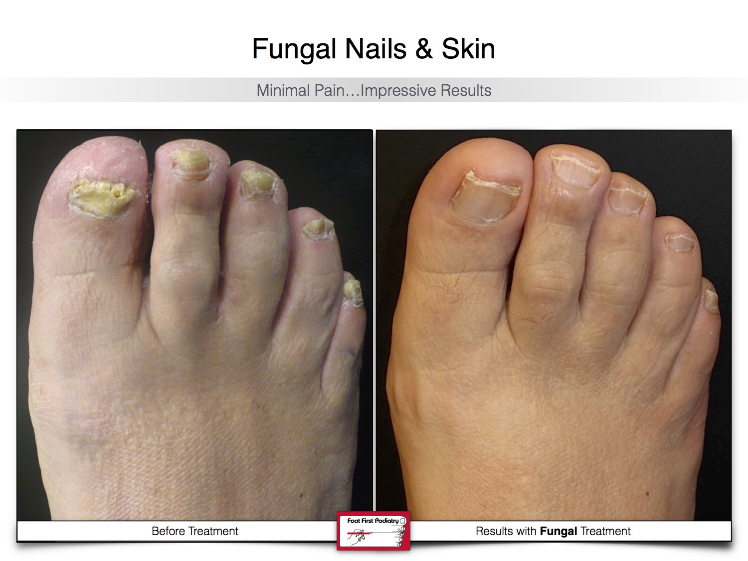 Fungal Nails & Skin 02.16 23.jpg