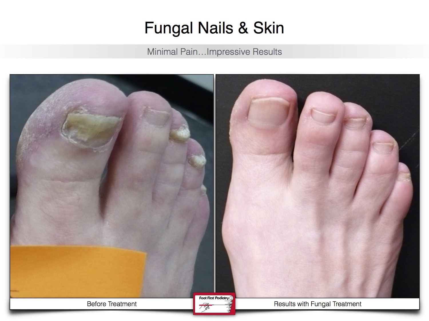 Fungal Nails & Skin 02.16 19.jpg