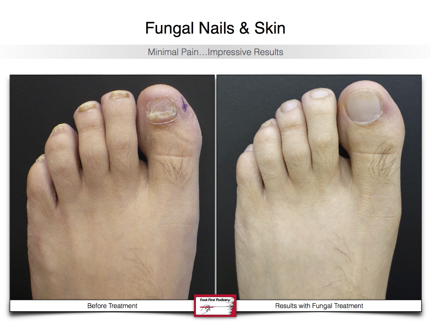 Fungal Nails & Skin 02.16 24.jpg