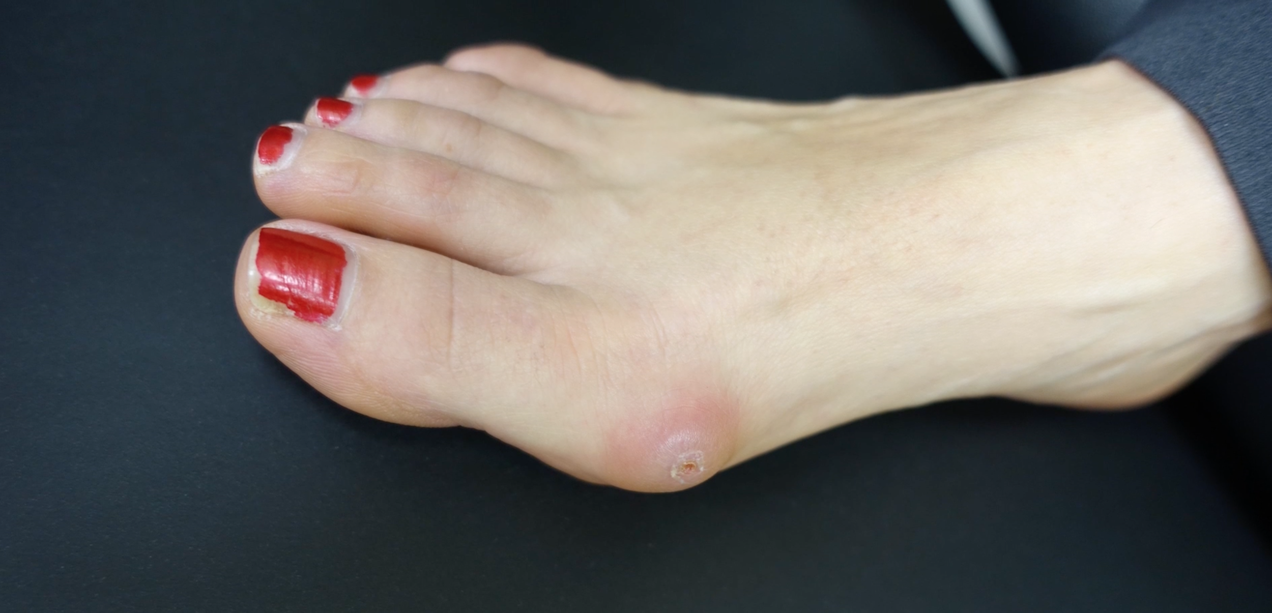 Bunions — Foot First Podiatry Centers