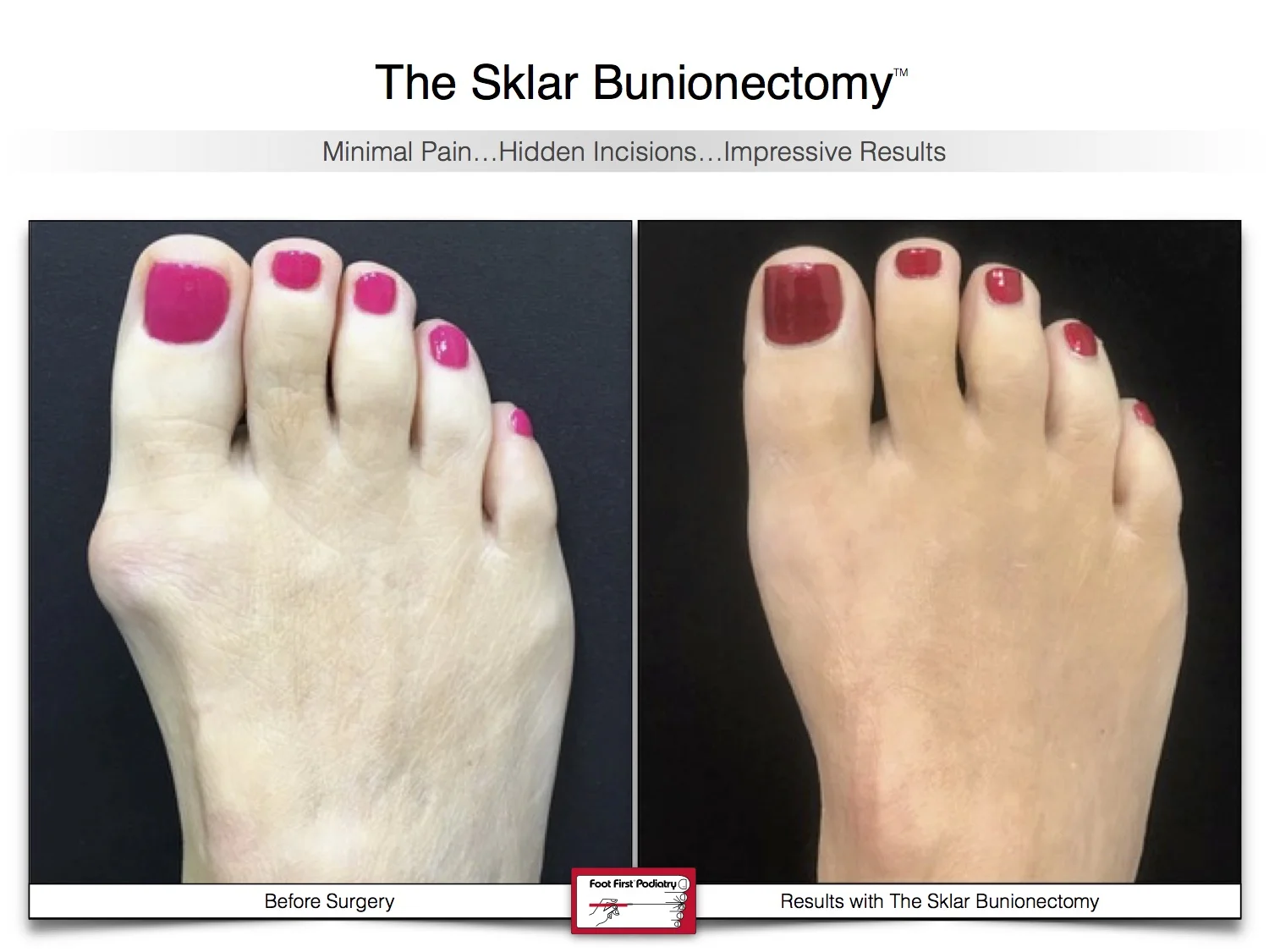 Sklar Bunionectomy 5 | Website 02.17 .jpg