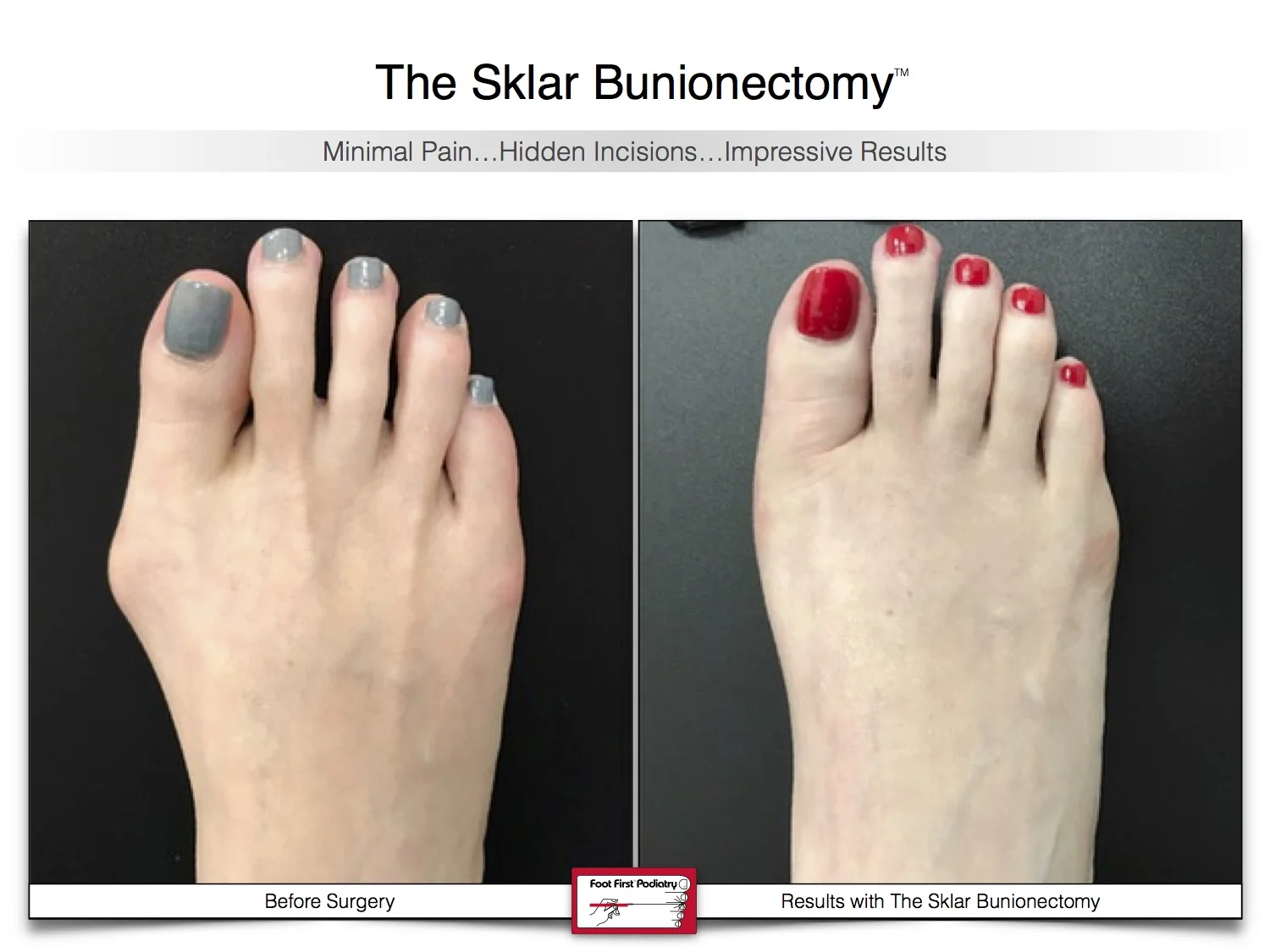 Sklar Bunionectomy 8 | Website 02.17 .jpg