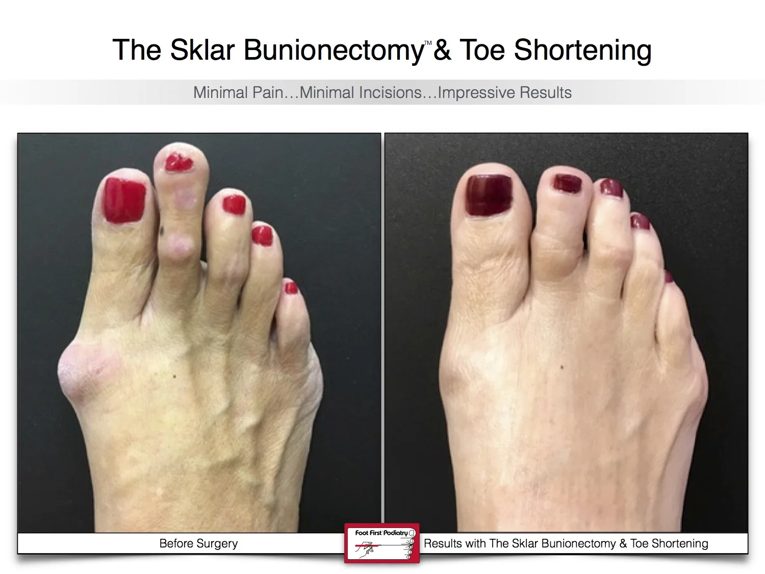 sklar-bunionectomy-toe-shortening-bunion-before-and-after-12.jpg