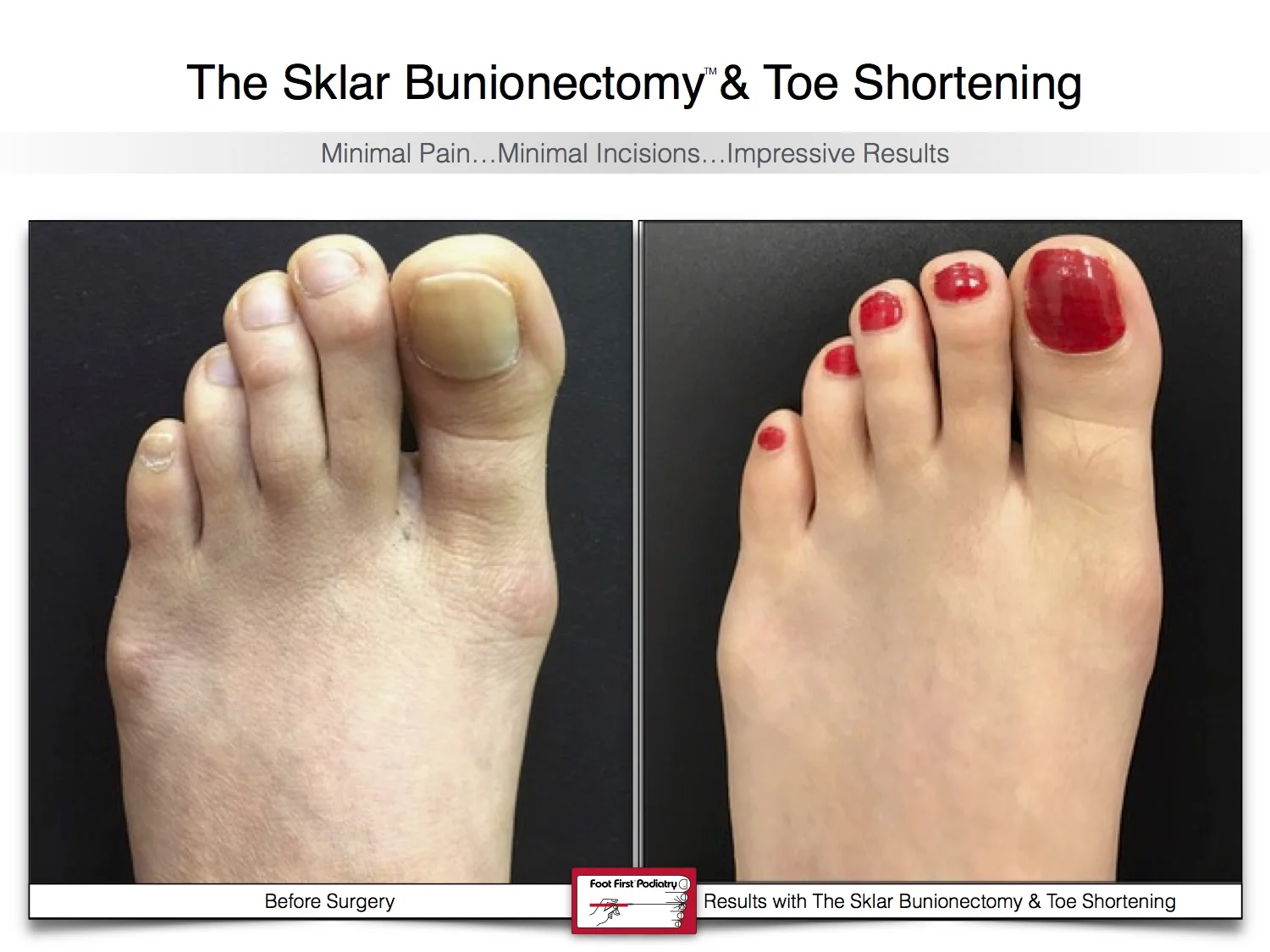 sklar-bunionectomy-toe-shortening-bunion-before-and-after-13-2.jpg