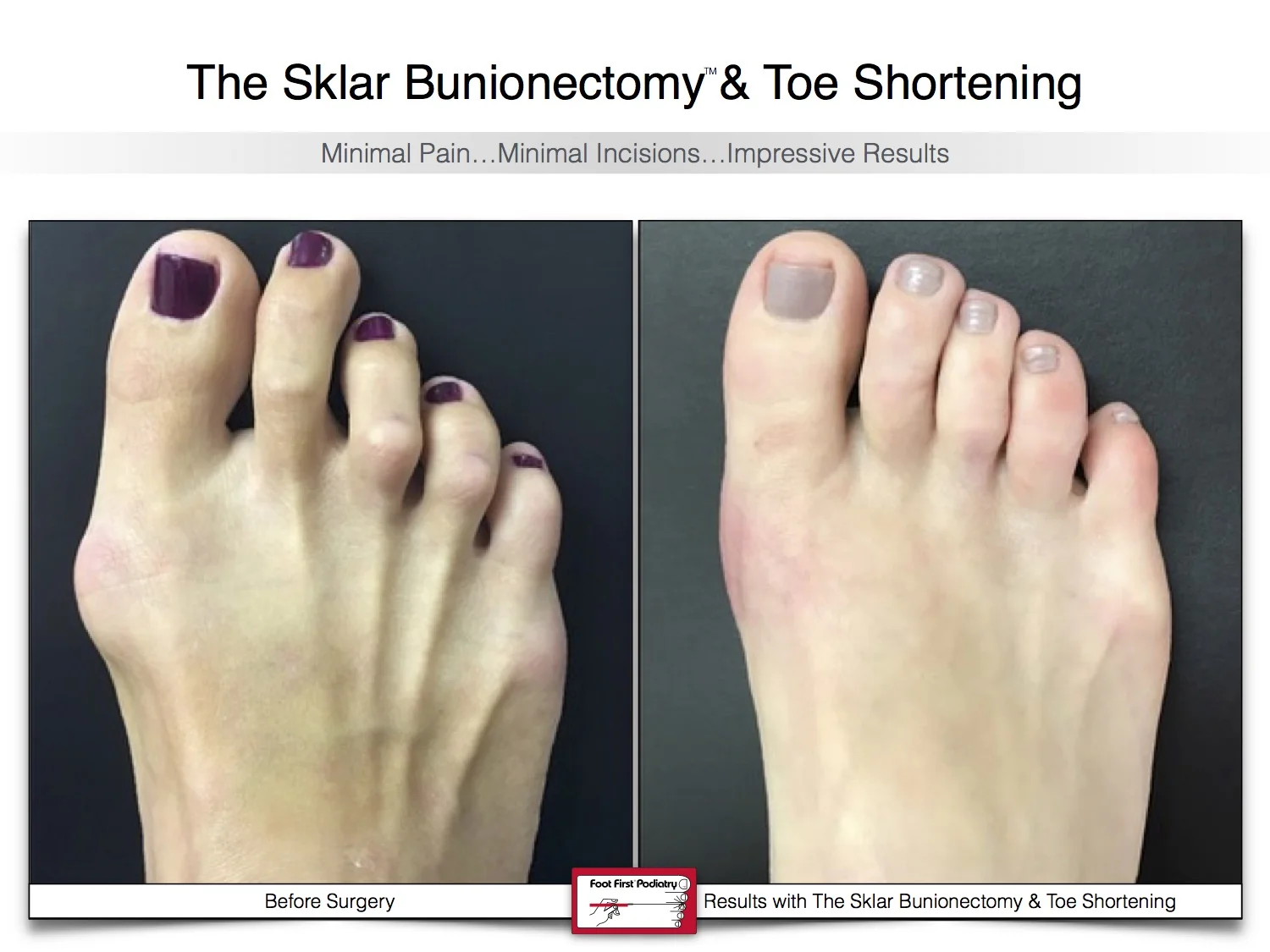 sklar-bunionectomy-toe-shortening-bunion-before-and-after-14.jpg