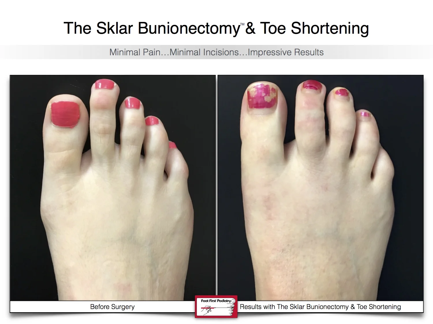 sklar-bunionectomy-toe-shortening-bunion-before-and-after-15.jpg
