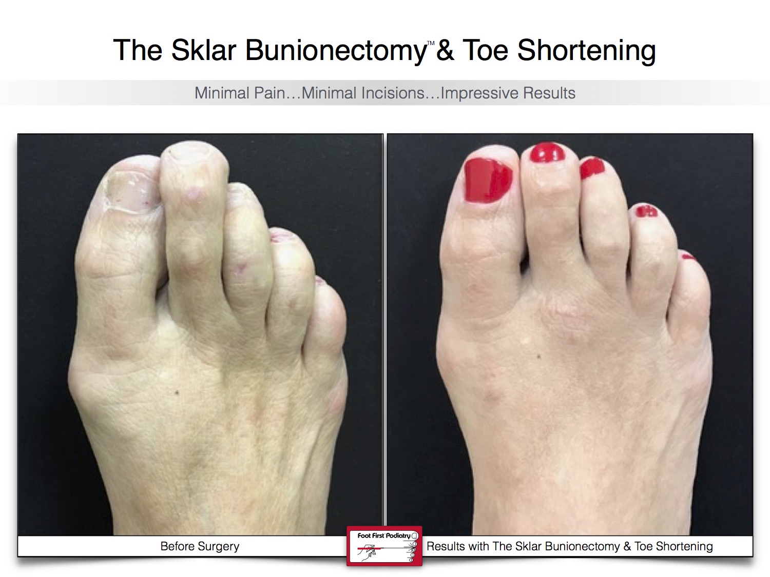 sklar-bunionectomy-toe-shortening-bunion-before-and-after-17.jpg