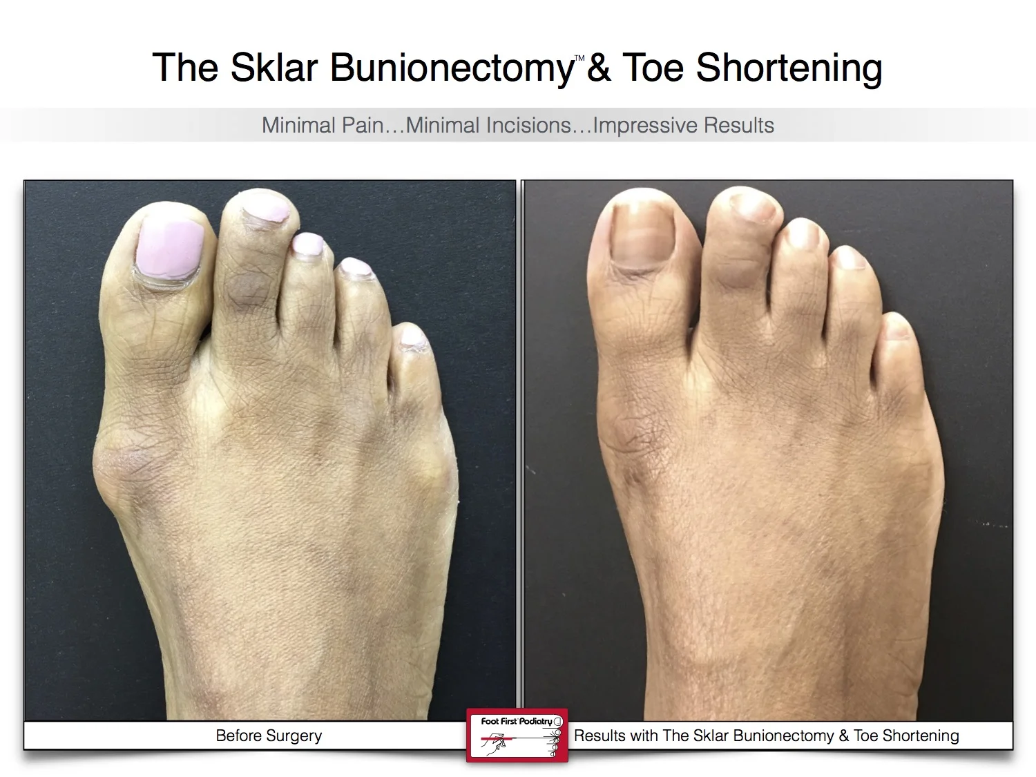 sklar-bunionectomy-toe-shortening-bunion-before-and-after-16.jpg