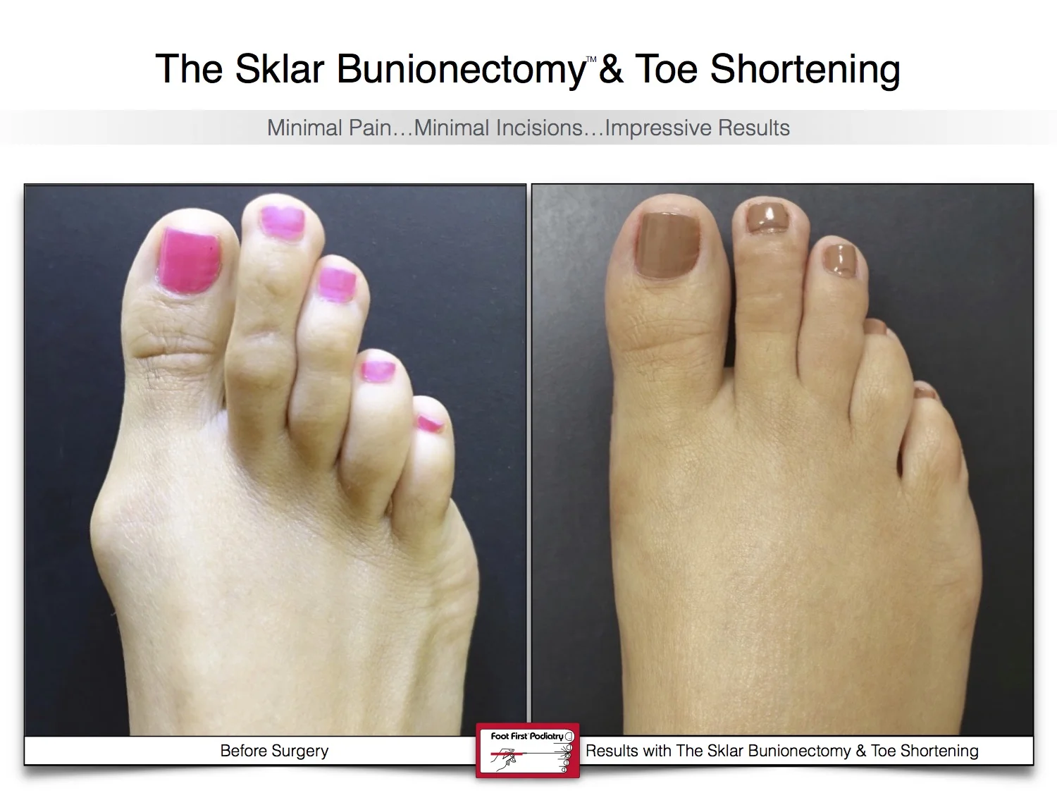 sklar-bunionectomy-toe-shortening-bunion-before-and-after-18-2.jpg