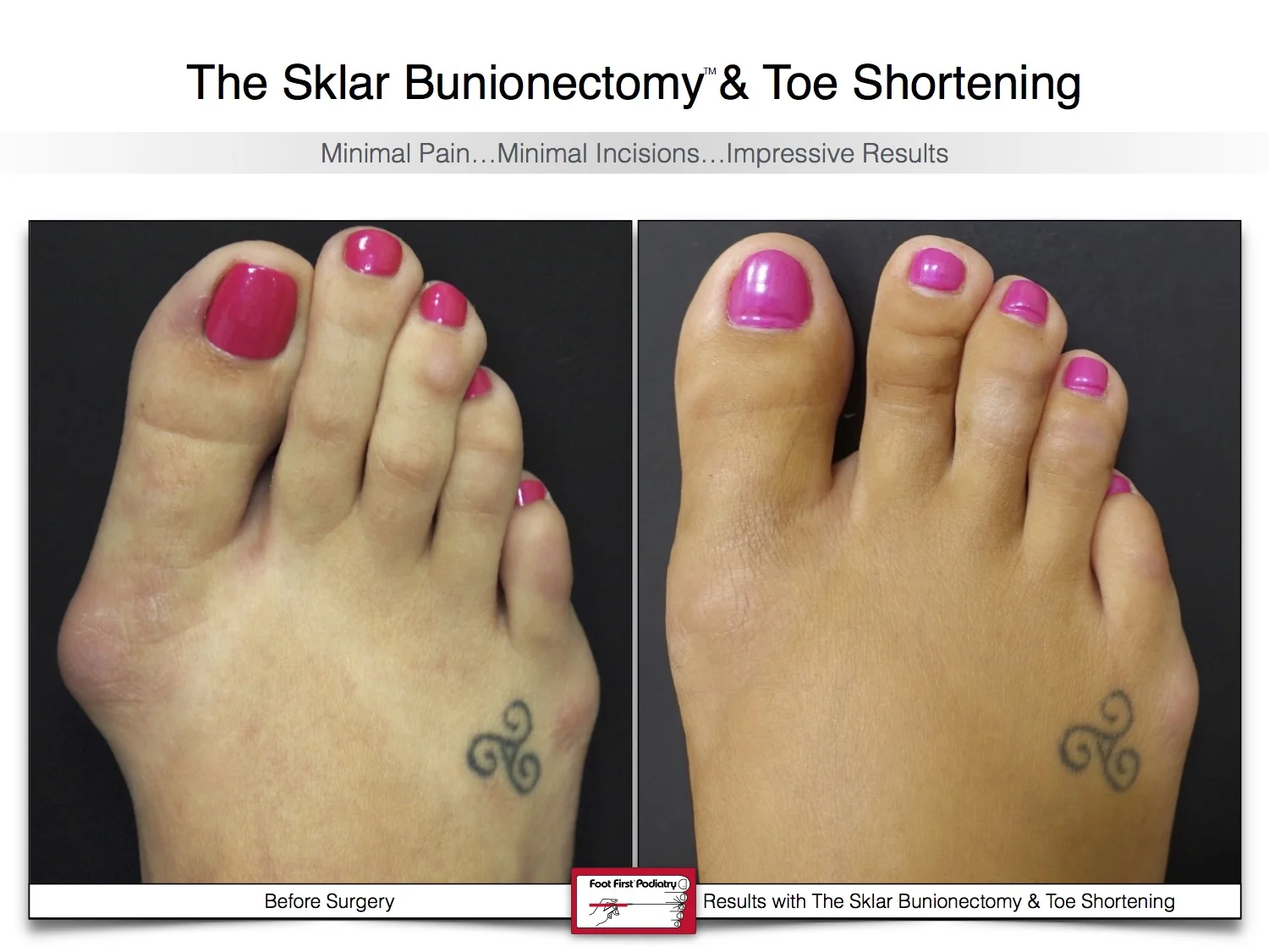sklar-bunionectomy-toe-shortening-bunion-before-and-after-19.jpg