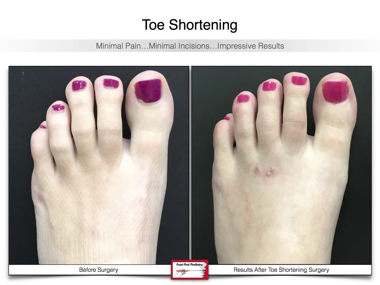 toe-shortening-before-and-after-21.jpg