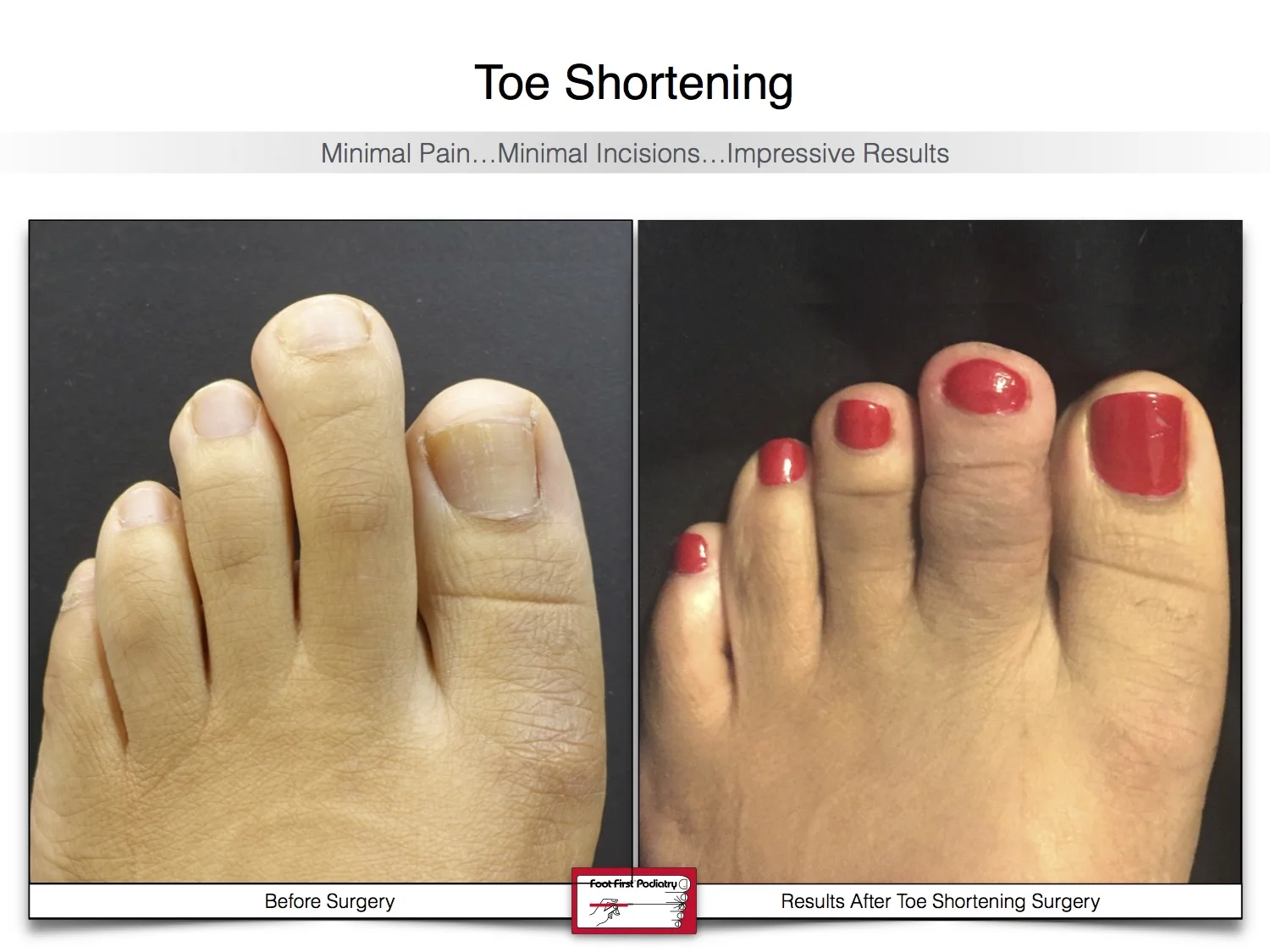 toe-shortening-before-and-after-20.jpg