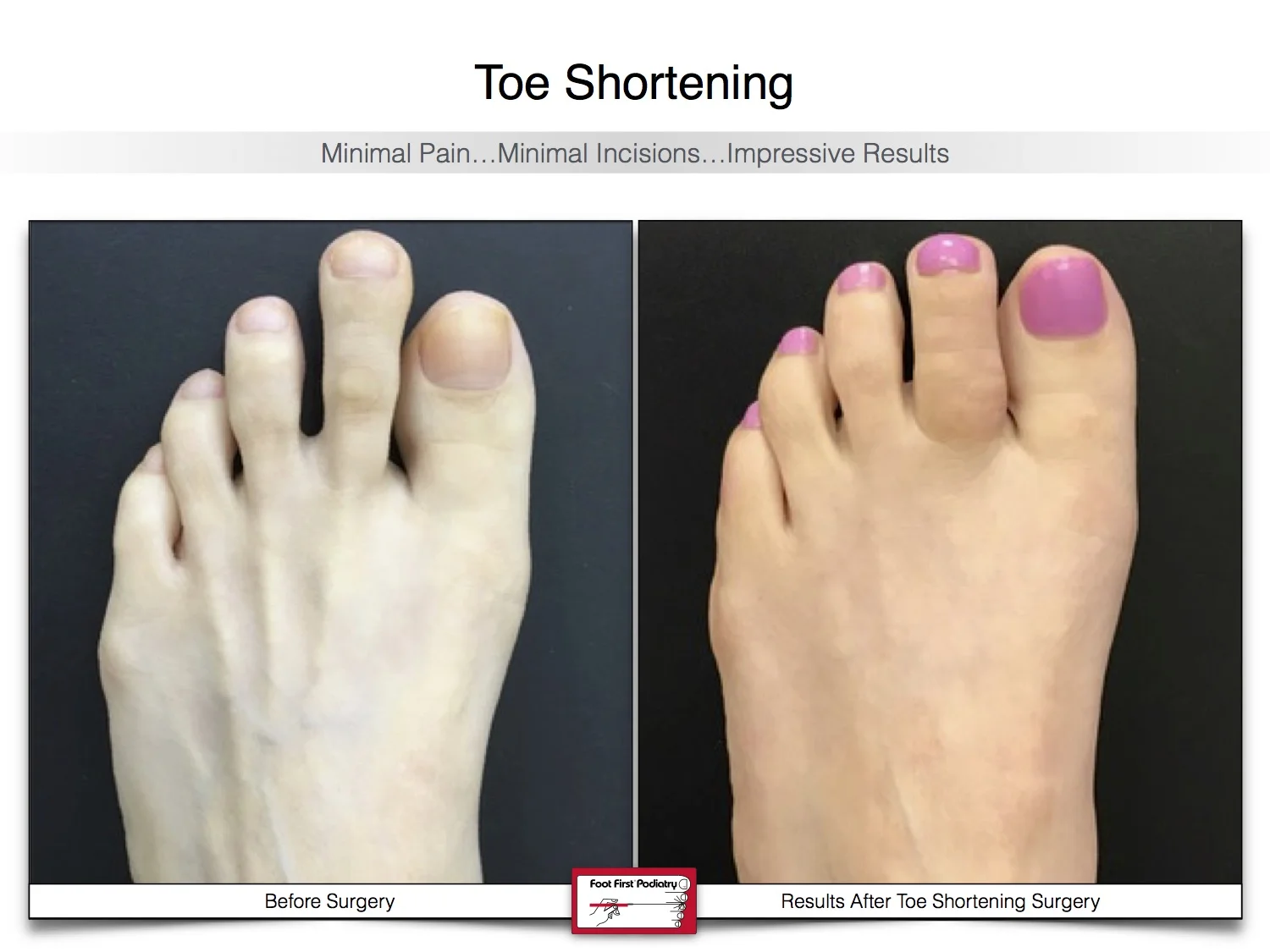 toe-shortening-before-and-after-22.jpg