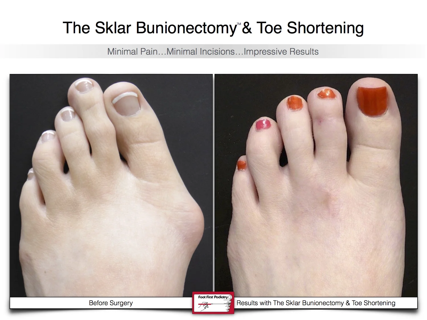 bunion-surgery-toe-shortening-before-and-after-13.jpg