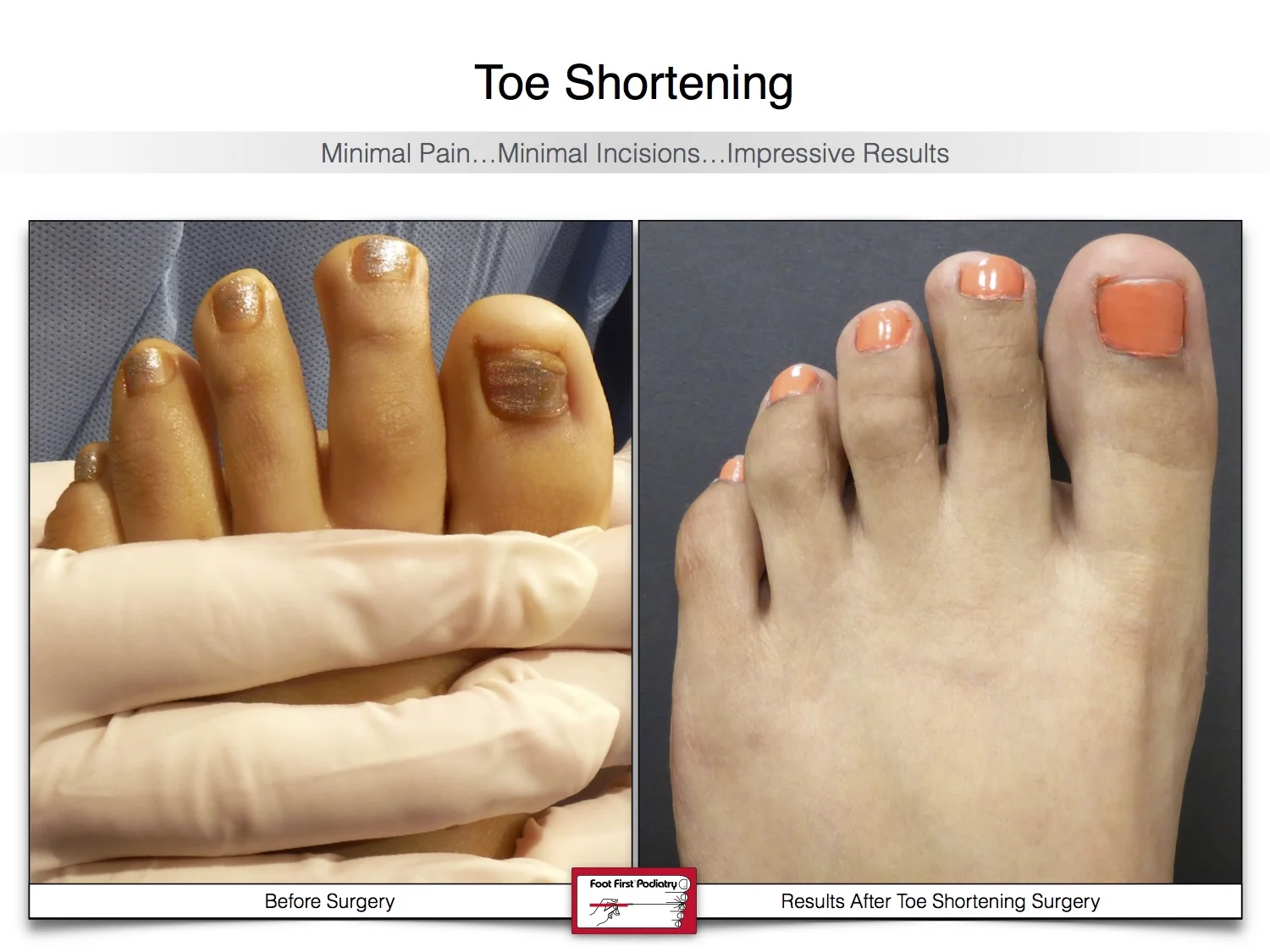 bunion-surgery-toe-shortening-before-and-after-39.jpg