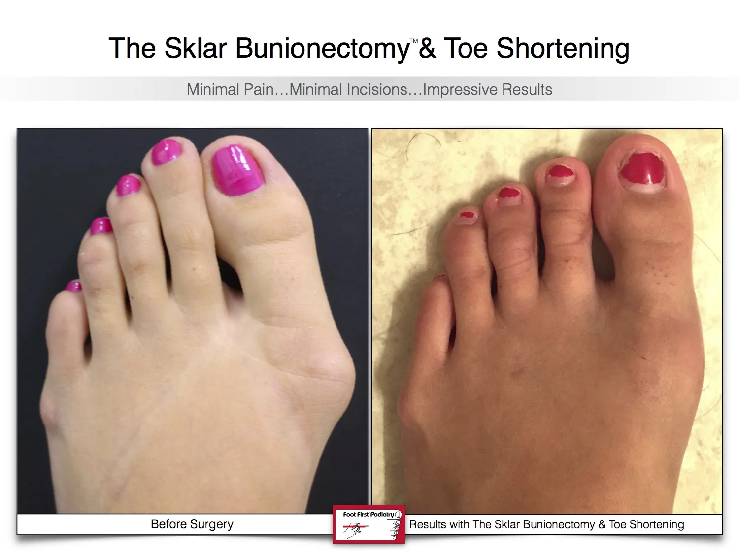 bunion-surgery-toe-shortening-before-and-after-59-2.jpg