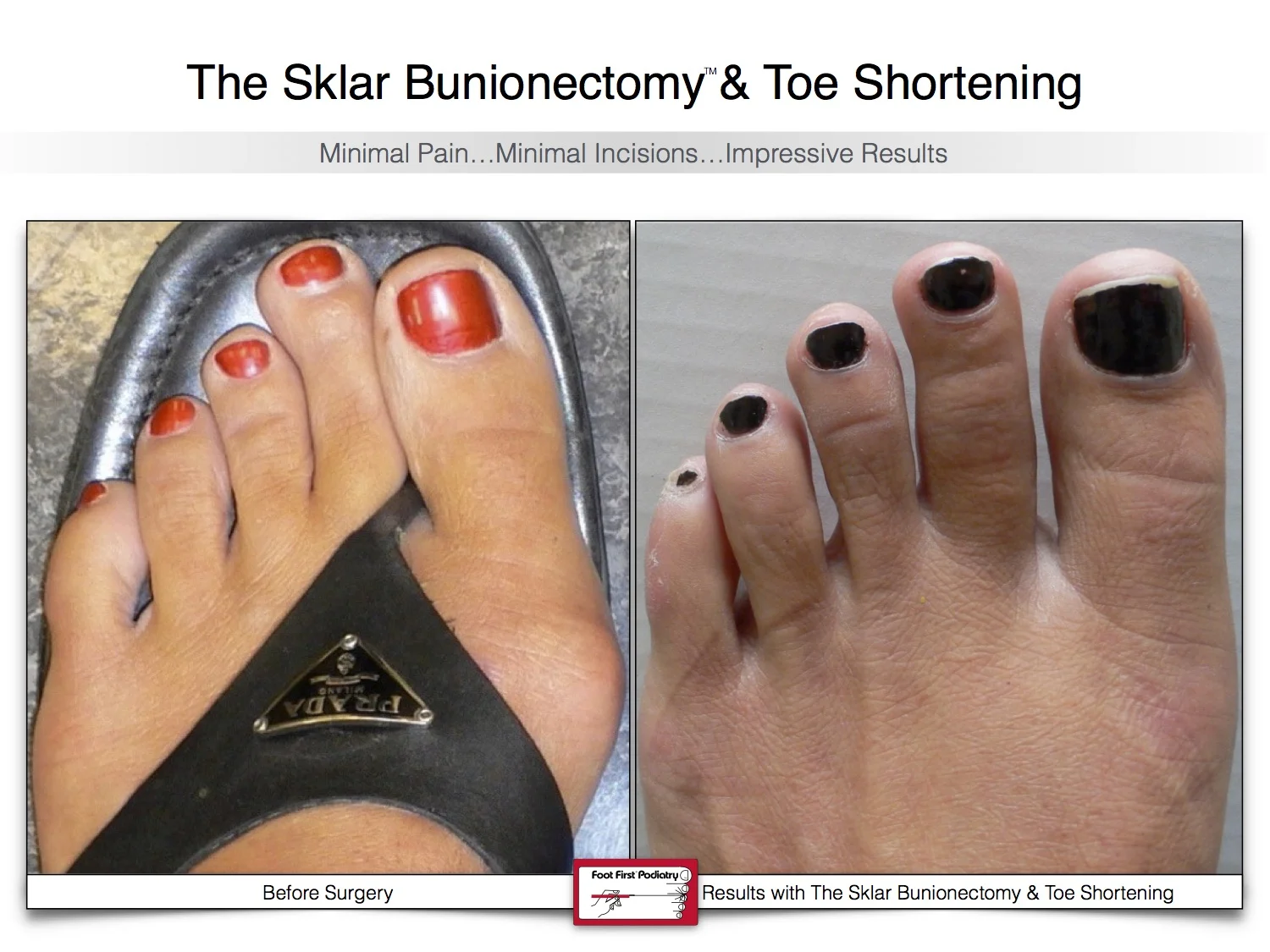 bunion-surgery-toe-shortening-before-and-after-40.jpg