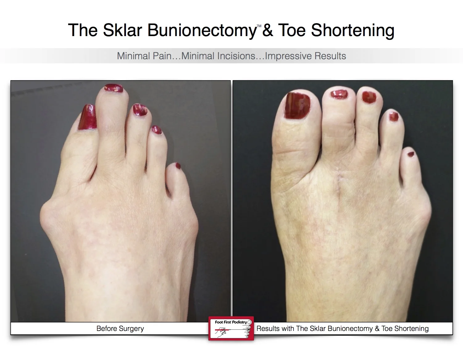 bunion-surgery-toe-shortening-before-and-after-92.jpg