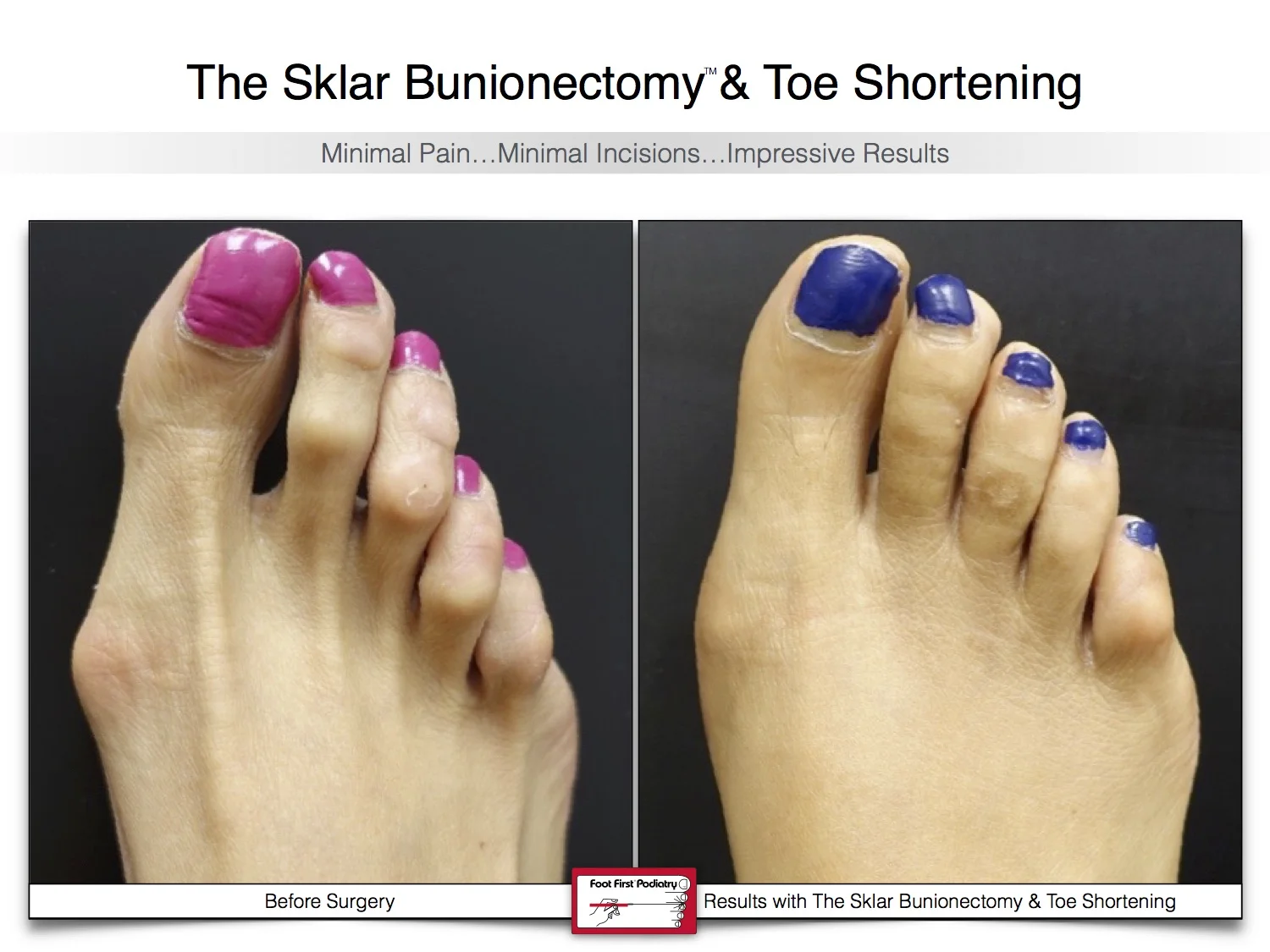 bunion-surgery-toe-shortening-before-and-after-93.jpg