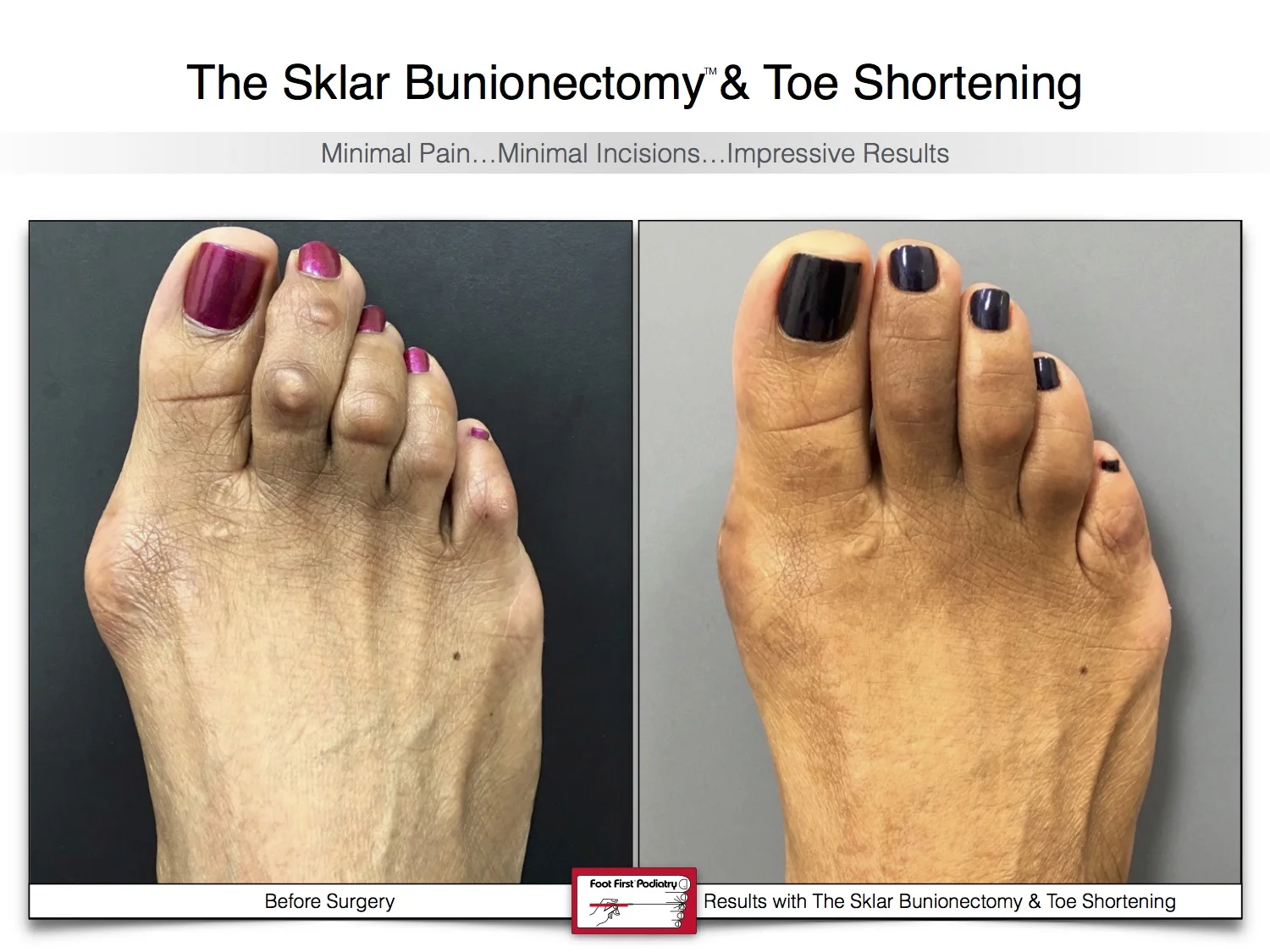 bunion-surgery-toe-shortening-before-and-after-94.jpg