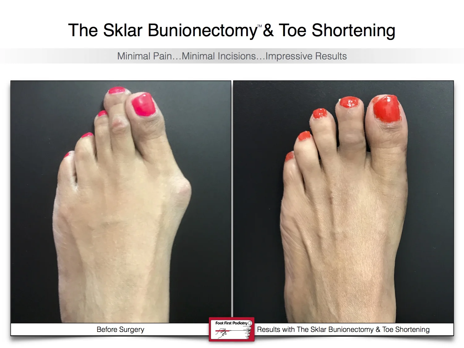 bunion-surgery-toe-shortening-before-and-after-27.jpg