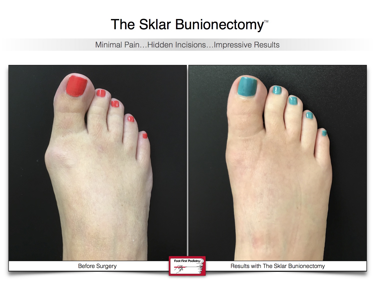 bunion-surgery-before-and-after-sklar-bunionectomy-32-s.jpg
