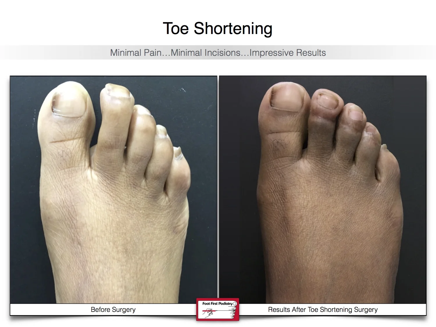 bunion-surgery-toe-shortening-before-and-after-36.jpg