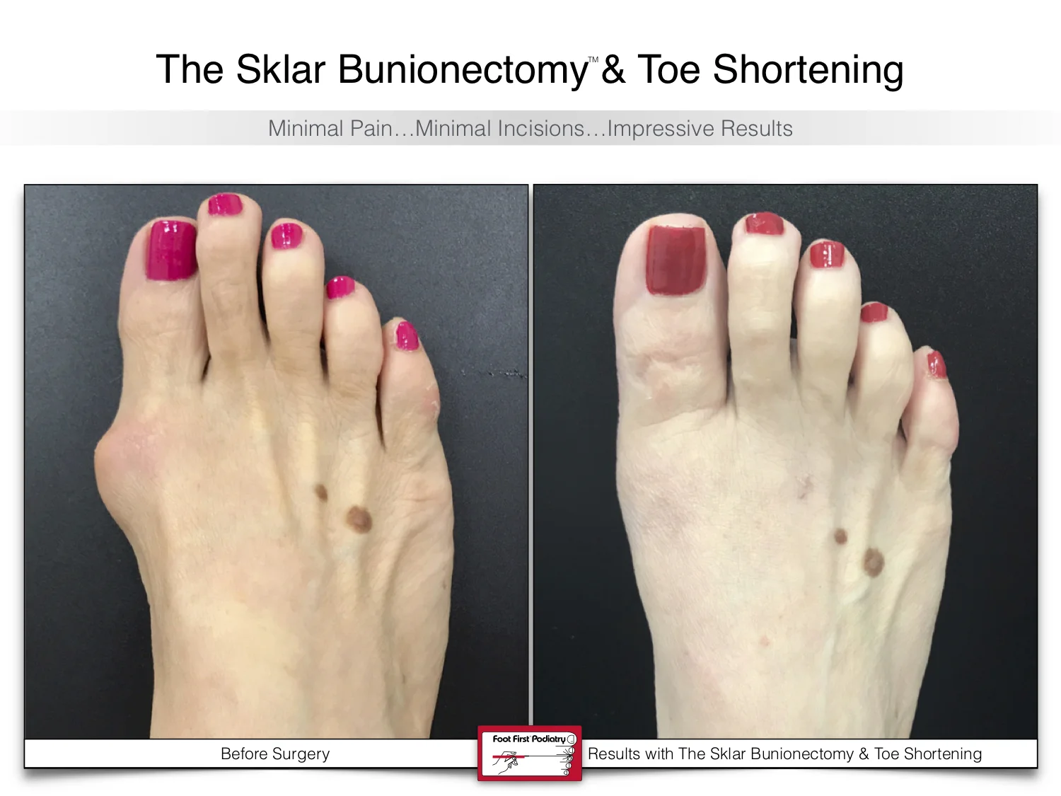 bunion-surgery-toe-shortening-before-and-after-60.jpg