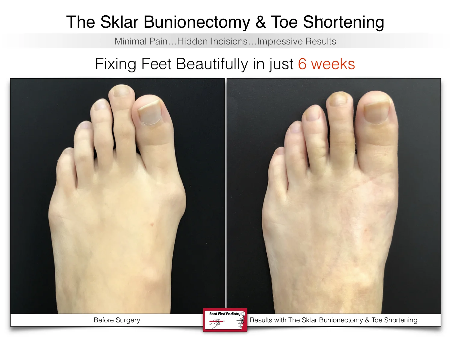 bunion-surgery-toe-shortening-before-and-after-59.jpg