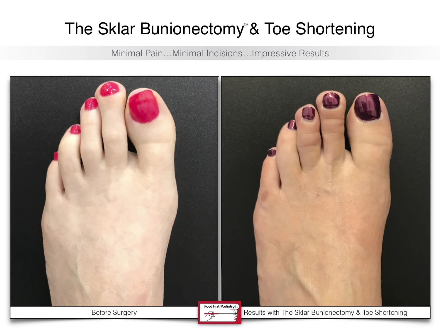 bunion-surgery-toe-shortening-before-and-after-56.jpg