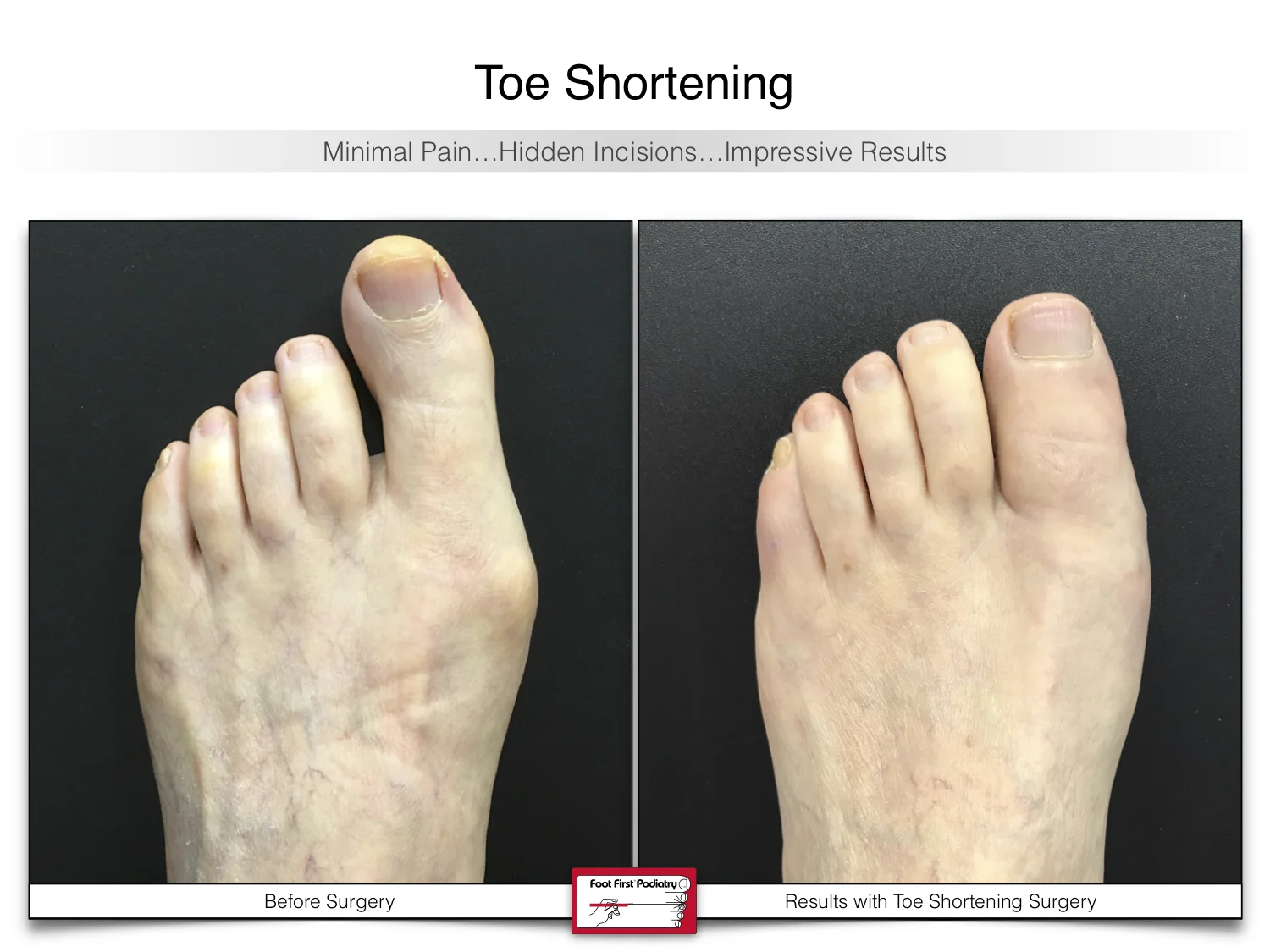 bunion-surgery-toe-shortening-before-and-after-55.jpg