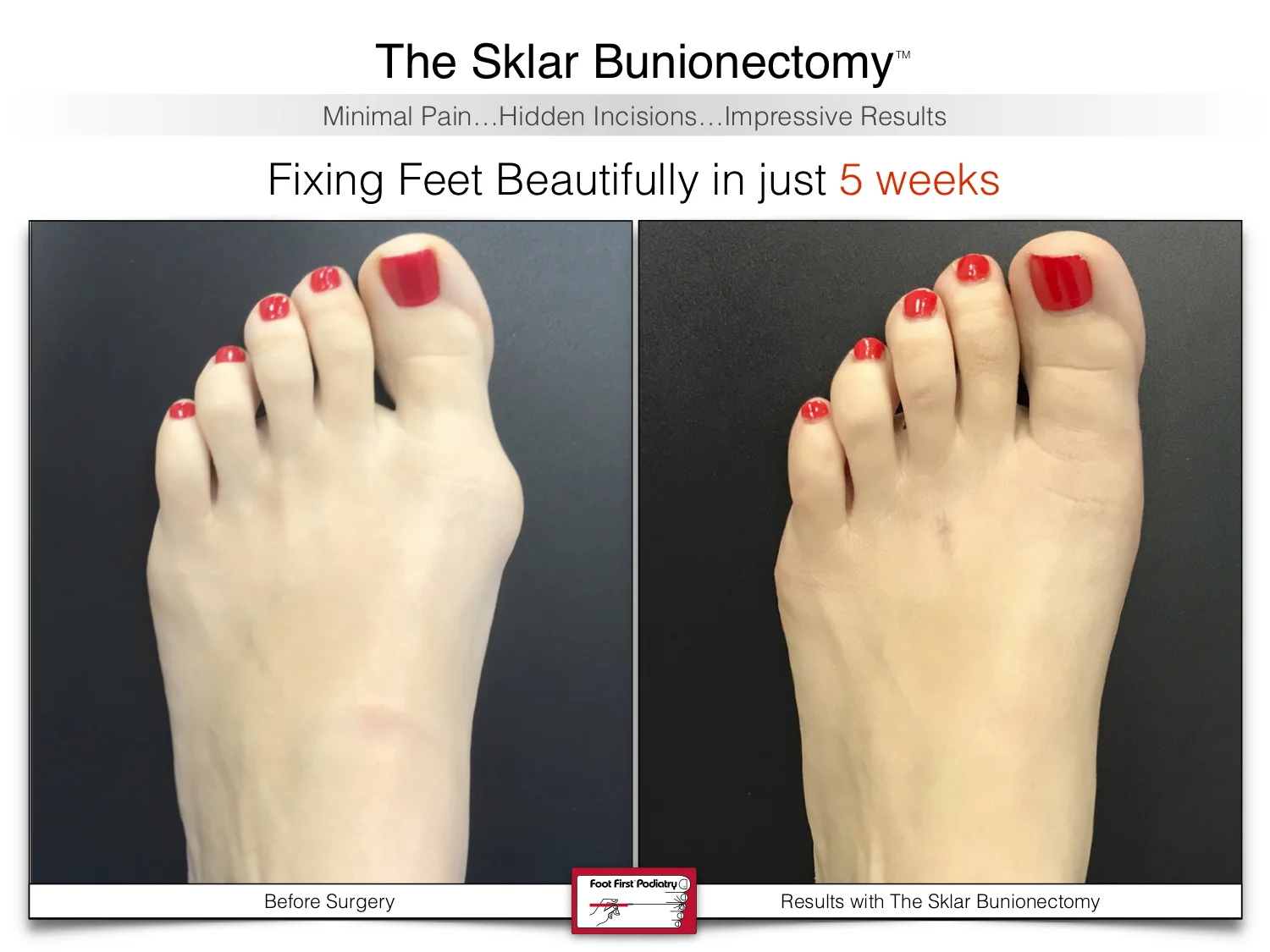 The Sklar Bunionectomy 2 | www.footfirst.com .jpg