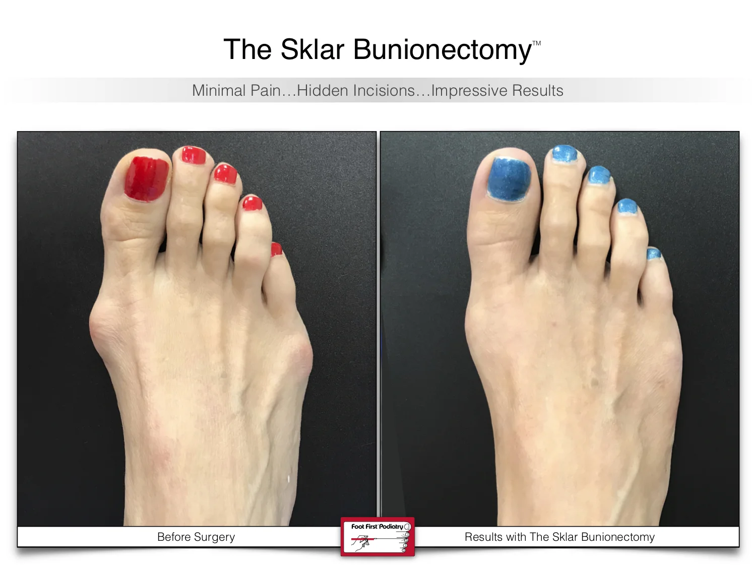 bunion-surgery-before-and-after-sklar-bunionectomy-88.jpg