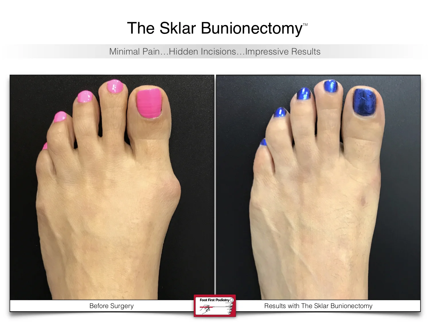 bunion-surgery-before-and-after-sklar-bunionectomy-91-4.jpg