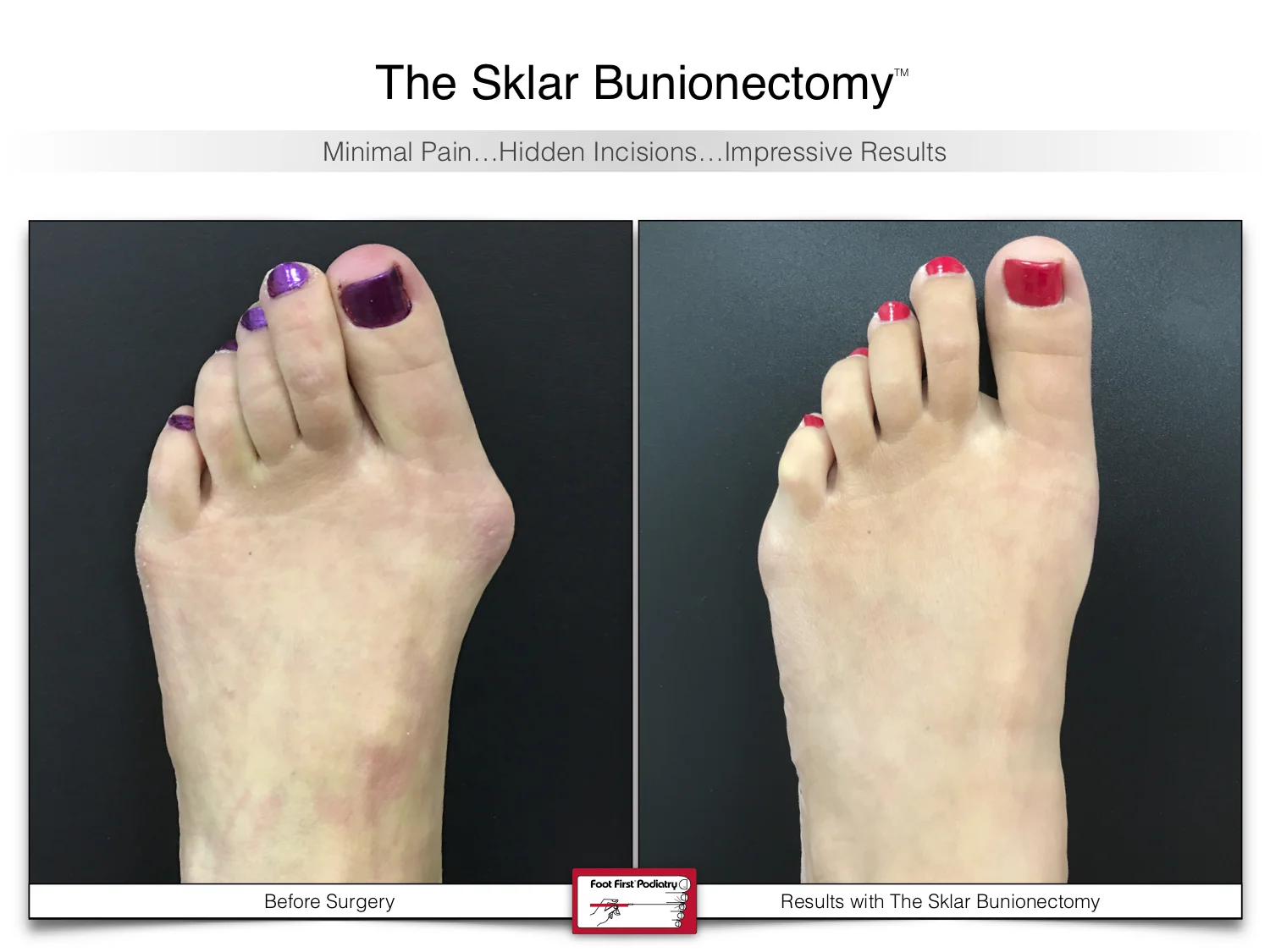 bunion-surgery-before-and-after-sklar-bunionectomy-93.jpg