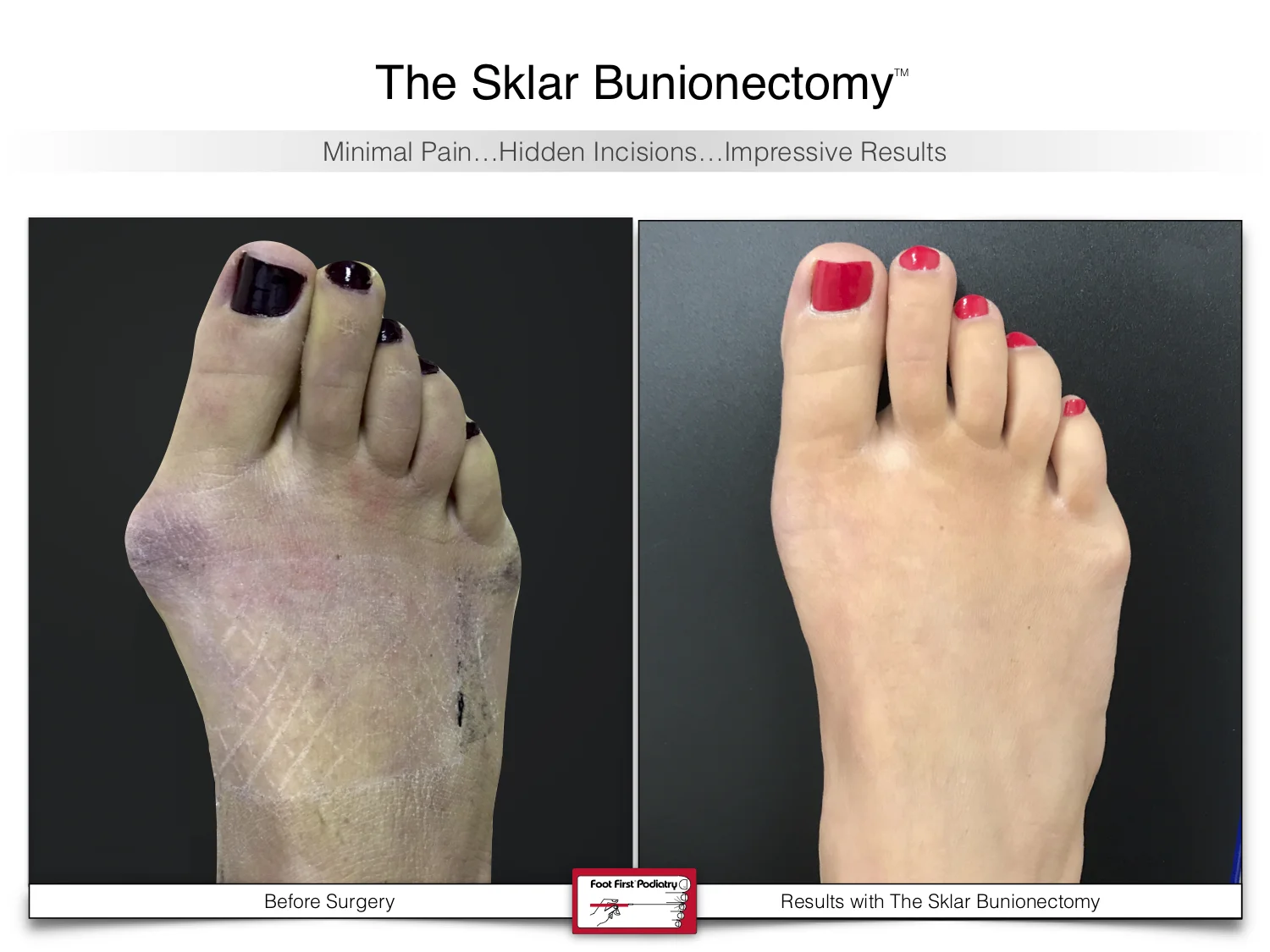 bunion-surgery-before-and-after-sklar-bunionectomy-94.jpg
