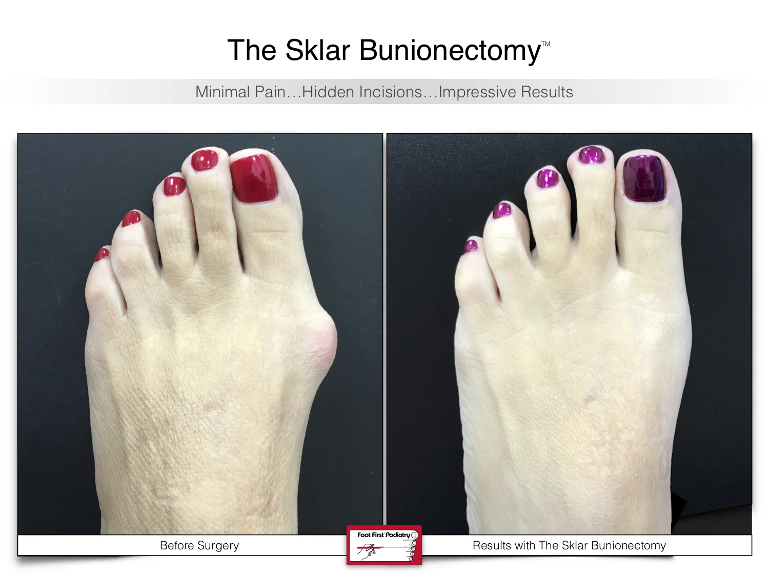 bunion-surgery-before-and-after-sklar-bunionectomy-96.jpg