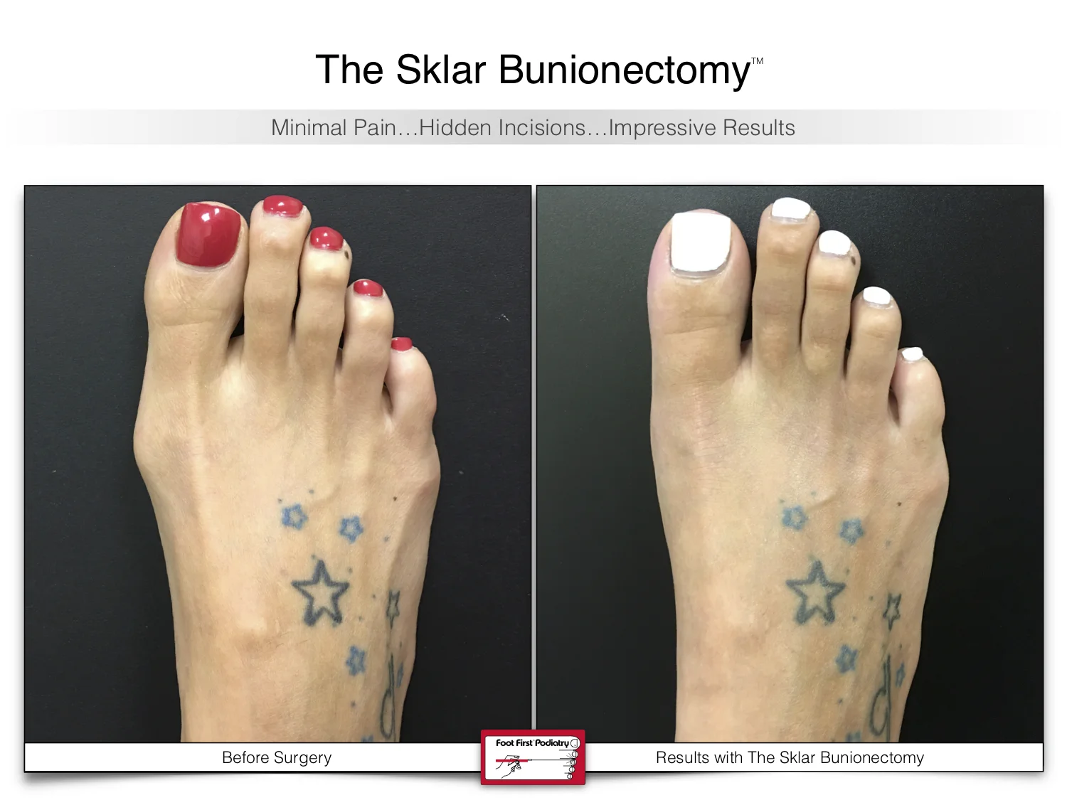 bunion-surgery-before-and-after-sklar-bunionectomy-97-2.jpg