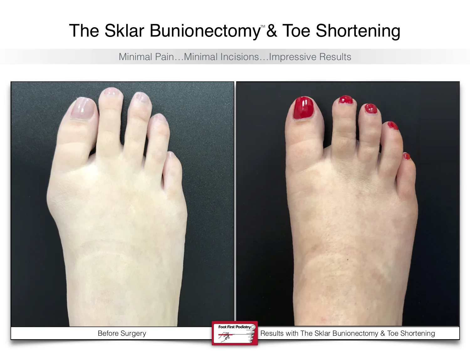 bunion-surgery-toe-shortening-before-and-after-101.jpg
