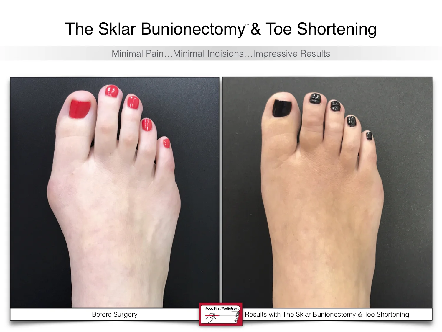 bunion-surgery-toe-shortening-before-and-after-100.jpg