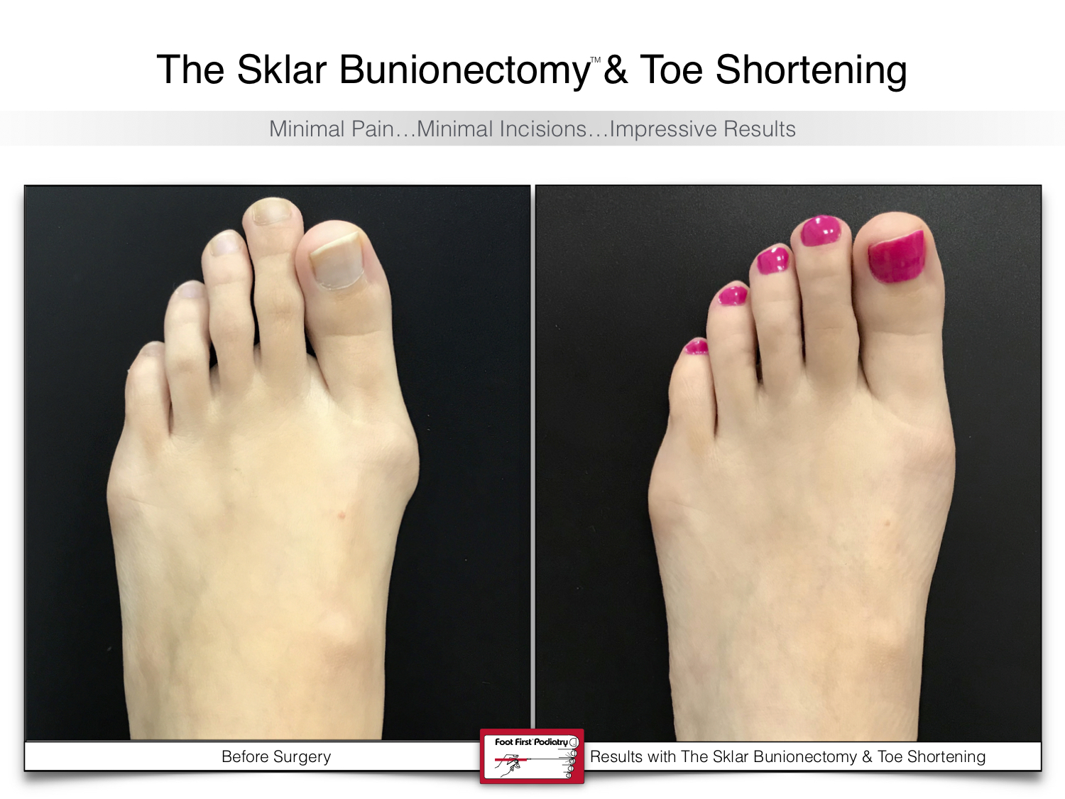 bunion-surgery-toe-shortening-before-and-after-103.jpg