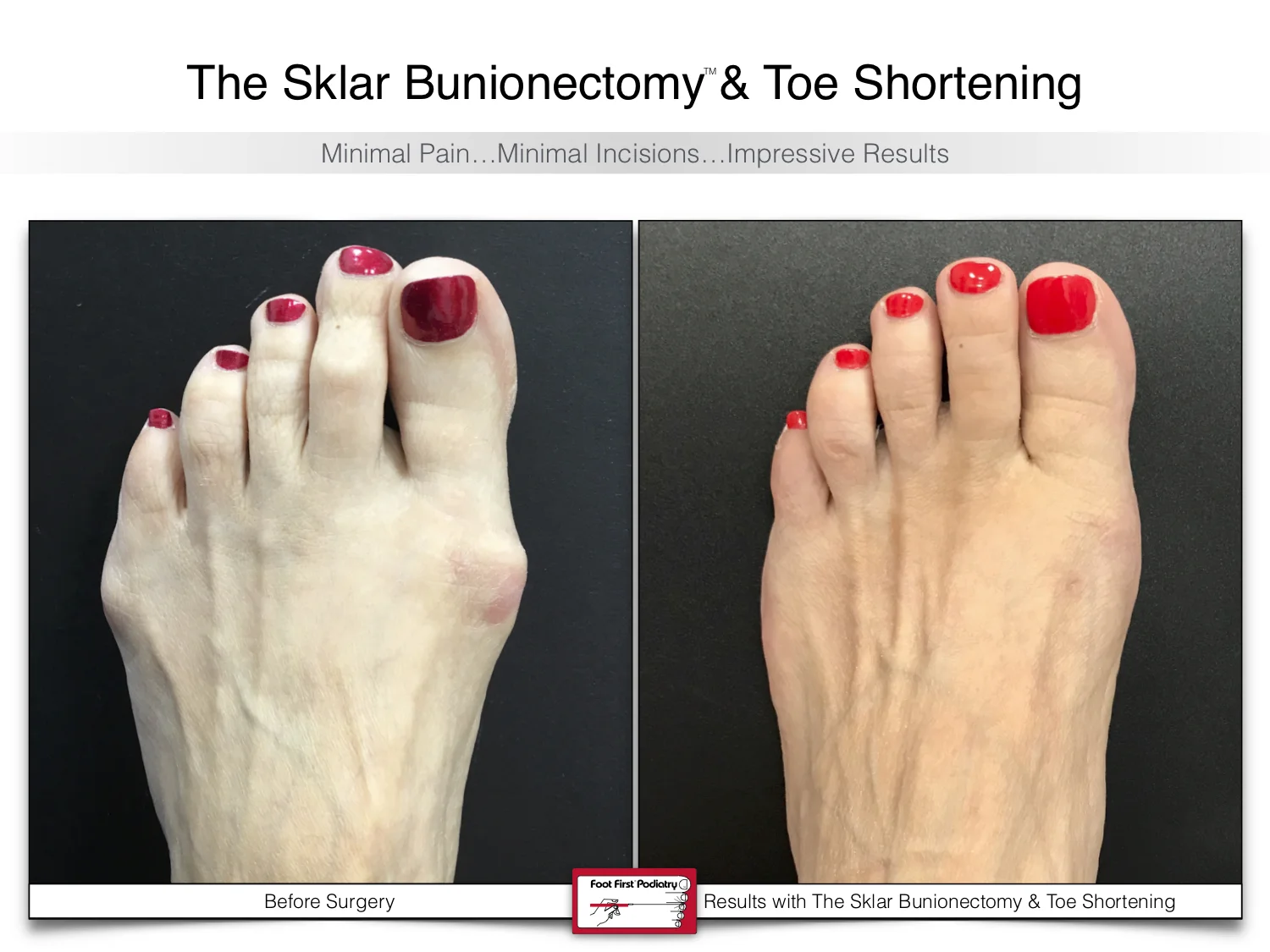 bunion-surgery-toe-shortening-before-and-after-102.jpg