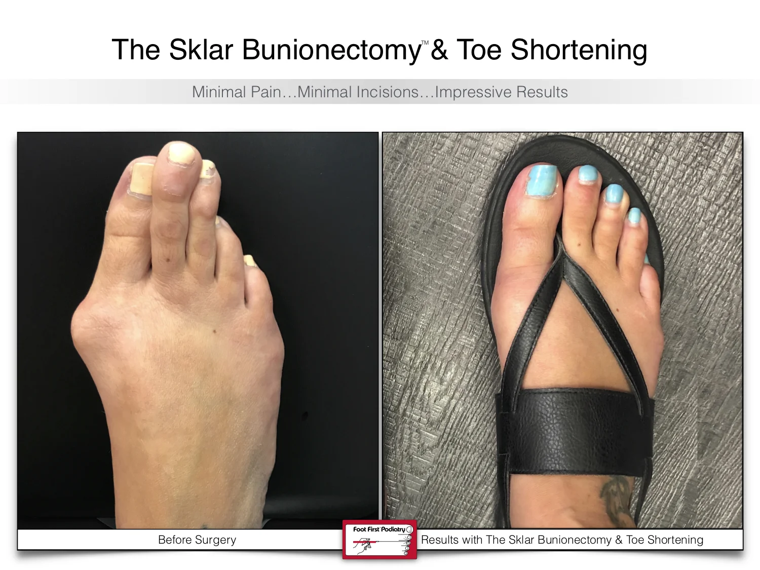 bunion-surgery-toe-shortening-before-and-after-99.jpg