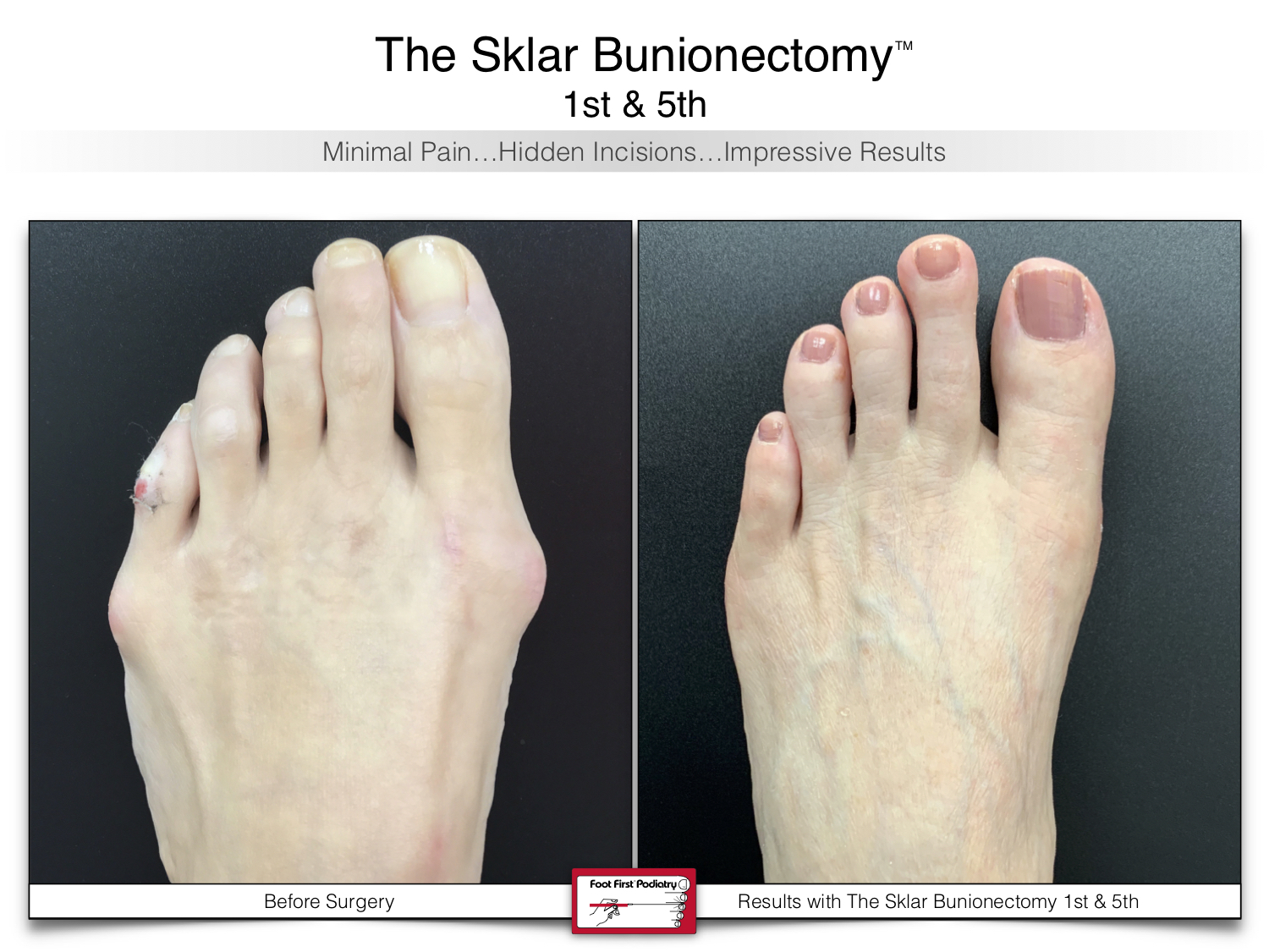 www.footfirst.com | Cosmetic Bunion and Toe Shortening Surgery 109.jpg