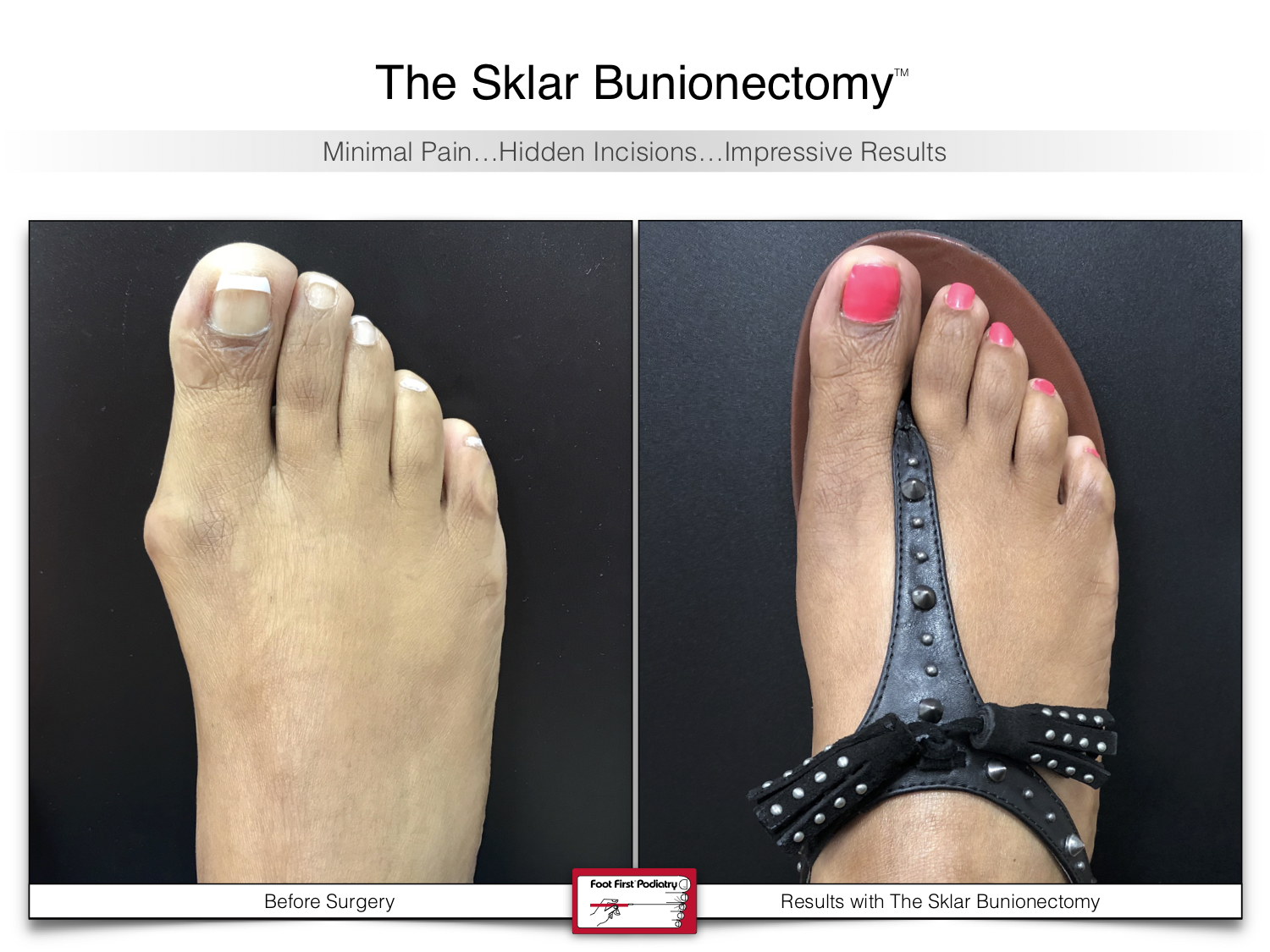 www.footfirst.com | Cosmetic Bunion and:or Toe Shortening Surgery 112.jpg