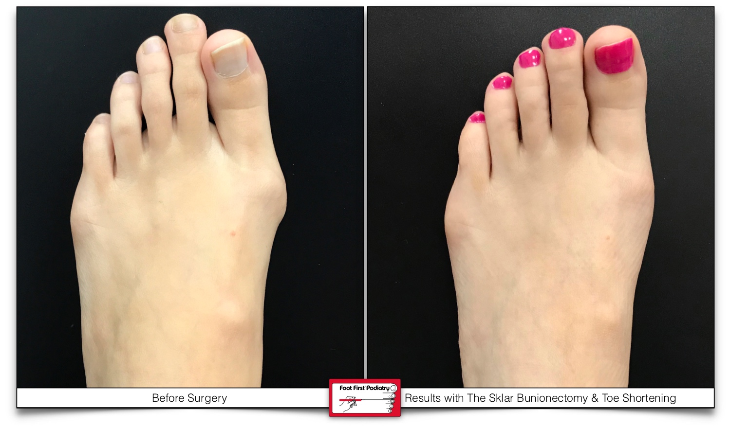 Long, short, curled or even just plain ugly toes? At Foot First we can fix  that! — Foot First Podiatry Centers
