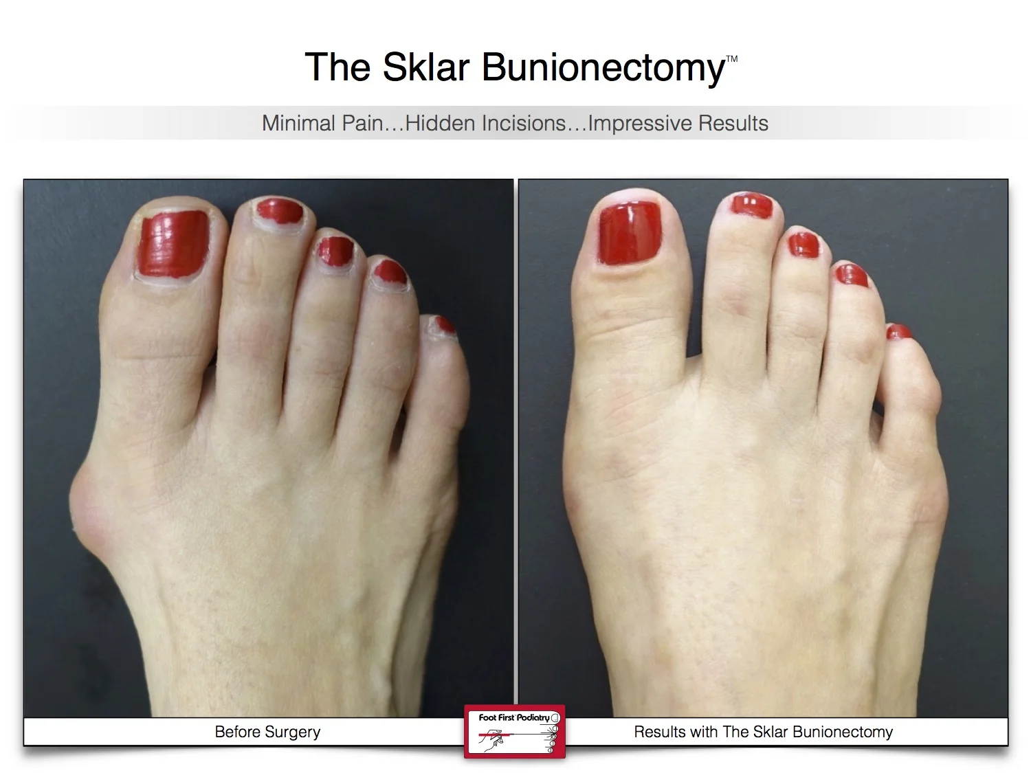 bunion-surgery-before-and-after-sklar-bunionectomy-14.jpg