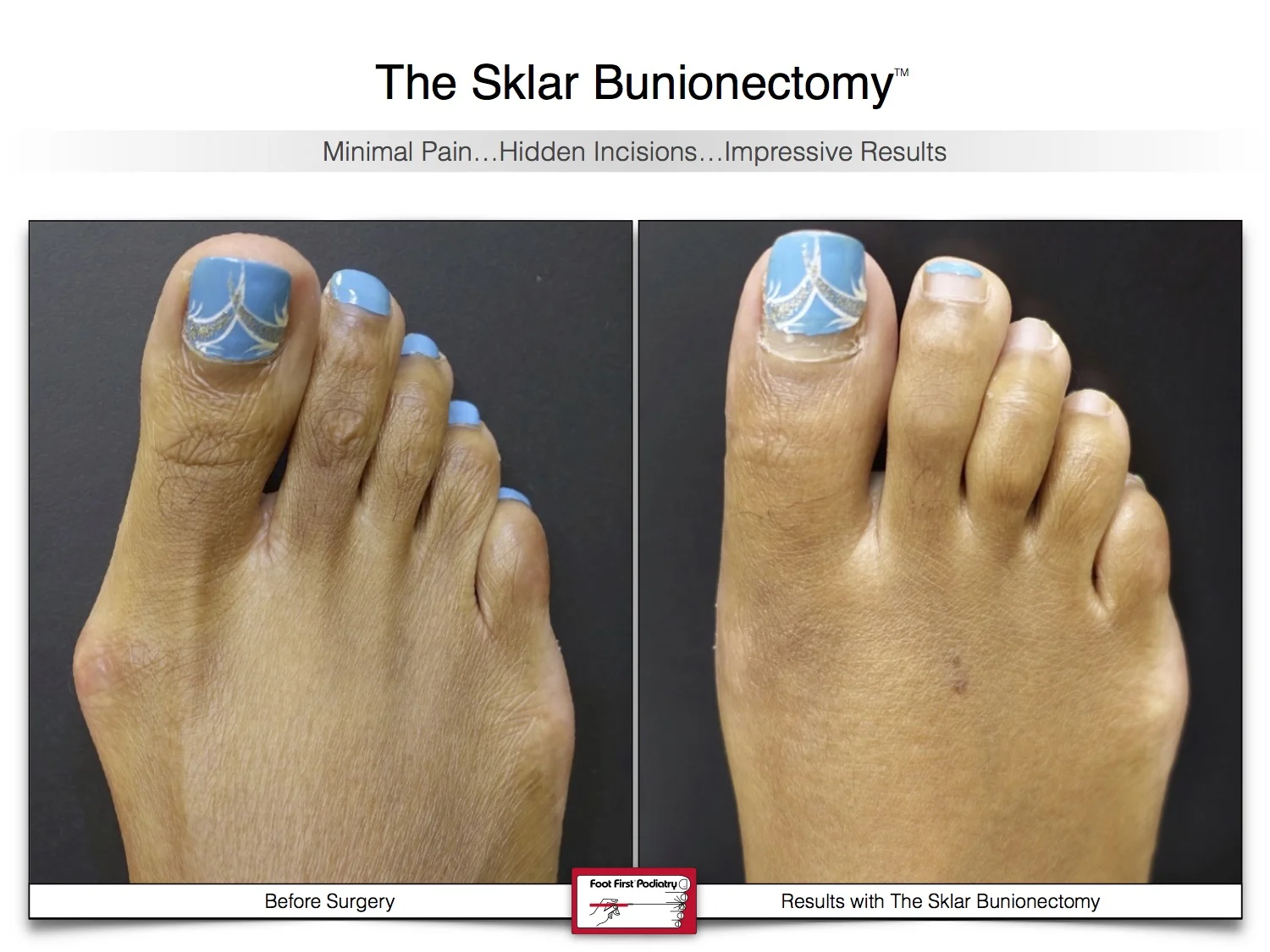 bunion-surgery-before-and-after-sklar-bunionectomy-15.jpg